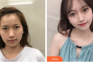 武漢華美醫(yī)療整形美容醫(yī)院葉子榮整形價(jià)格表附自體脂肪填充案例展示