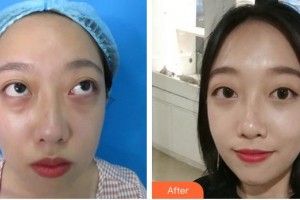 曲靖市第一人民醫(yī)院醫(yī)學(xué)整形美容科陳華林整形價格表附激光去眼袋案例展示