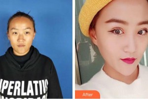 曲靖愛爾眼科醫(yī)院張光學(xué)整形價格表附眼部綜合案例展示