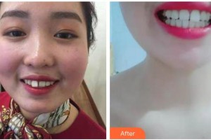 曲靖卓美口腔門診部梁沙整形價(jià)格表附牙齒隱形矯正案例展示