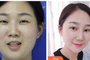 玉溪愛(ài)爾眼科醫(yī)院肖莉麗整形價(jià)格表附眼部綜合案例展示