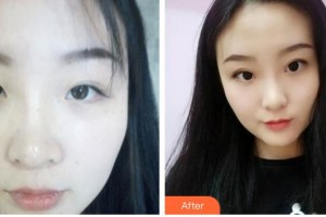 玉溪愛爾眼科醫(yī)院劉莎利整形價格表附眼部綜合案例展示