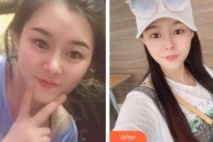 玉溪愛(ài)爾眼科醫(yī)院林泉整形價(jià)格表附內(nèi)切祛眼袋案例展示