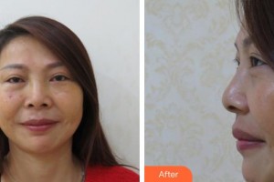 玉溪愛(ài)爾眼科醫(yī)院蘇銳整形價(jià)格表附眶隔脂肪釋放案例展示