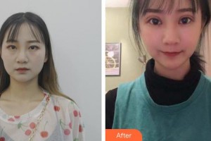 玉溪愛爾眼科醫(yī)院胡亞麗整形價(jià)格表附眼部綜合案例展示