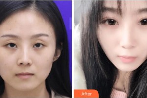 玉溪愛爾眼科醫(yī)院劉超整形價格表附眼部修復案例展示