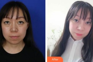 玉溪華山眼科醫(yī)院馬吉維整形價格表附外切祛眼袋案例展示