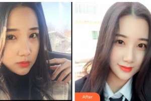 保山德康口腔醫(yī)院郭躍華整形價(jià)格表附金屬托槽矯正案例展示