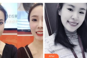 昭通愛麗諾醫(yī)療美容門診部潘玉支整形價格表附超聲波潔牙案例展示