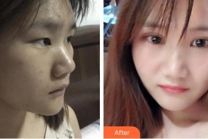 昭通愛麗諾醫(yī)療美容門診部朱姍姍整形價格表附埋線雙眼皮案例展示