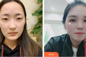 昭通愛麗諾醫(yī)療美容門診部馮冠宇整形價格表附切開雙眼皮案例展示