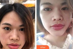 昭通愛麗諾醫(yī)療美容門診部唐文齊整形價格表附眼部修復案例展示