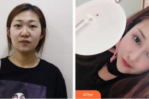 昭通愛麗諾醫(yī)療美容門診部陳志江整形價格表附切開雙眼皮案例展示