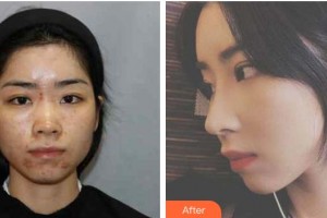 昭通瑪麗婦產(chǎn)醫(yī)院整形美容科李廷勛整形價格表附鼻部綜合案例展示