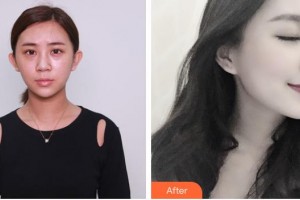 昭通瑪麗婦產(chǎn)醫(yī)院整形美容科曺秀沇整形價格表附膨體隆鼻案例展示