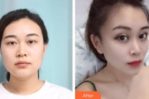 臨滄光明眼科醫(yī)院張波涌整形價(jià)格表附切開雙眼皮案例展示