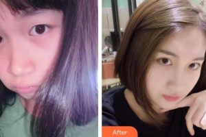 河南省立眼科醫(yī)院王樹林整形價格表附眼部綜合案例展示