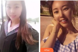 河南省立眼科醫(yī)院黃愛國整形價格表附切開雙眼皮案例展示