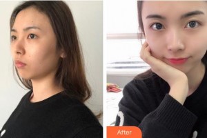 河南省立眼科醫(yī)院賀燚整形價格表附眼部綜合案例展示