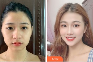 武漢美嘉整形美容醫(yī)院李靜整形價格表附自體脂肪填充案例展示