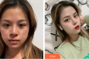 江蘇省蘇北人民醫(yī)院整形美容中心劉森整形價(jià)格表附微創(chuàng)疤痕修復(fù)案例展示