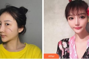 江蘇盛澤醫(yī)院醫(yī)學(xué)整形美容中心胡寅整形價(jià)格表附激光祛疤案例展示