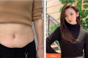 江蘇省人民醫(yī)院整形燒傷科湯建平整形價(jià)格表附祛妊娠紋案例展示