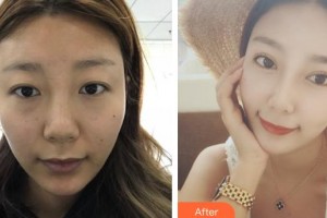 河北現(xiàn)代女子醫(yī)院整形美容中心趙國輝整形價格表附切開雙眼皮案例展示