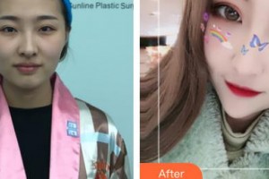 河北醫(yī)科大學第一醫(yī)院燒傷整形外科張慶富整形價格表附切開雙眼皮案例展示