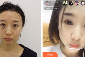 河北醫(yī)科大學第三醫(yī)院燒傷整形外科曹莫整形價格表附眼部綜合案例展示