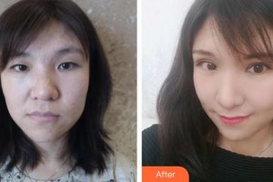 河北現(xiàn)代女子醫(yī)院整形美容中心曾慶明整形價(jià)格表附眼部綜合案例展示