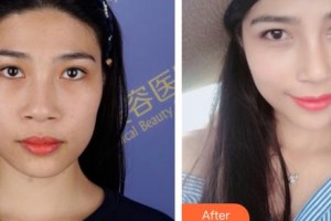 河北工程大學附屬醫(yī)院整形美容科袁好軍整形價格表附鼻部綜合案例展示