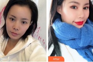 河北現(xiàn)代女子醫(yī)院整形美容中心易曉萍整形價(jià)格表附鼻部綜合案例展示