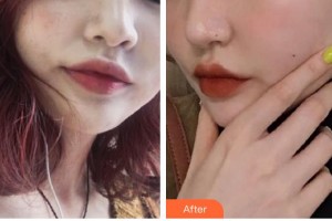 石家莊第一醫(yī)院整形科張寶成整形價(jià)格表附激光祛斑案例展示