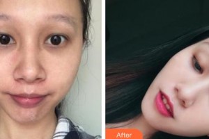 石家莊雅芳亞醫(yī)療美容醫(yī)院丁慶豐整形價(jià)格表附光子嫩膚案例展示