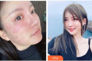 石家莊巍名仕醫(yī)療美容醫(yī)院何靜整形價(jià)格表附激光祛斑案例展示