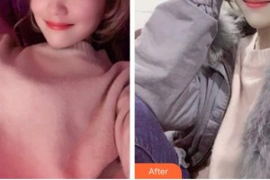 石家莊蘇亞美聯(lián)臣醫(yī)療美容醫(yī)院王俊祥整形價格表附超聲波潔牙案例展示