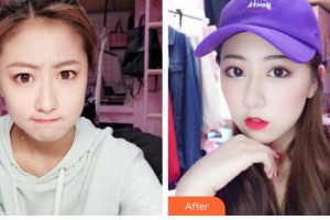 石家莊星源美天醫(yī)療美容醫(yī)院閆琨整形價(jià)格表附激光點(diǎn)痣案例展示