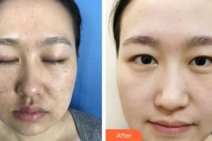 石家莊專家團(tuán)醫(yī)院胎記色斑診療中心王玉國整形價(jià)格表附激光點(diǎn)痣案例展示