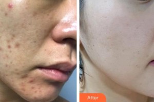 石家莊專家團(tuán)醫(yī)院胎記色斑診療中心李亞輝整形價格表附光子嫩膚案例展示