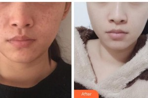 石家莊專家團(tuán)醫(yī)院胎記色斑診療中心齊麗整形價(jià)格表附清潔祛痘案例展示