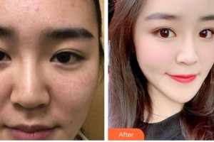 石家莊專家團(tuán)醫(yī)院胎記色斑診療中心陳曉晨整形價格表附鐳射凈膚案例展示