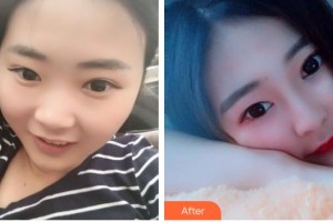 石家莊專家團(tuán)醫(yī)院胎記色斑診療中心丁振華整形價格表附紅藍(lán)光祛痘案例展示