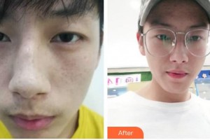 石家莊專家團(tuán)醫(yī)院胎記色斑診療中心馬海霞整形價格表附祛斑祛痣案例展示