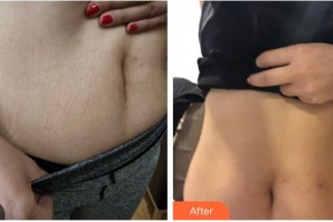 石家莊瑞貝爾醫(yī)療美容門診部何曉婭整形價格表附祛妊娠紋案例展示