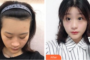 武漢美侖醫(yī)療美容門診部桂亮整形價(jià)格表附植發(fā)案例展示