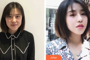 武漢華美醫(yī)療整形美容醫(yī)院劉琦整形價(jià)格表附皮膚美容案例展示