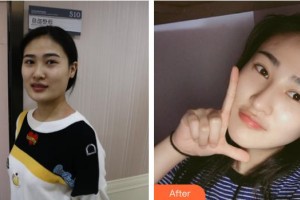 石家莊星源美天醫(yī)療美容醫(yī)院王秀整形價格表附切開雙眼皮案例展示