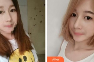 石家莊諾萬醫(yī)療美容醫(yī)院張斌整形價格表附清潔祛痘案例展示