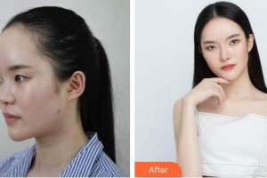 石家莊貴美人醫(yī)療美容醫(yī)院耿莉娟整形價(jià)格表附假體隆鼻例展示